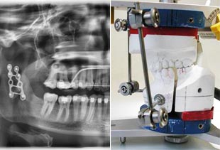 Orthognathe Chirurgie