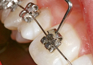 Selbstligierende Brackets