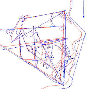 Visual Treatment Objective (VTO)